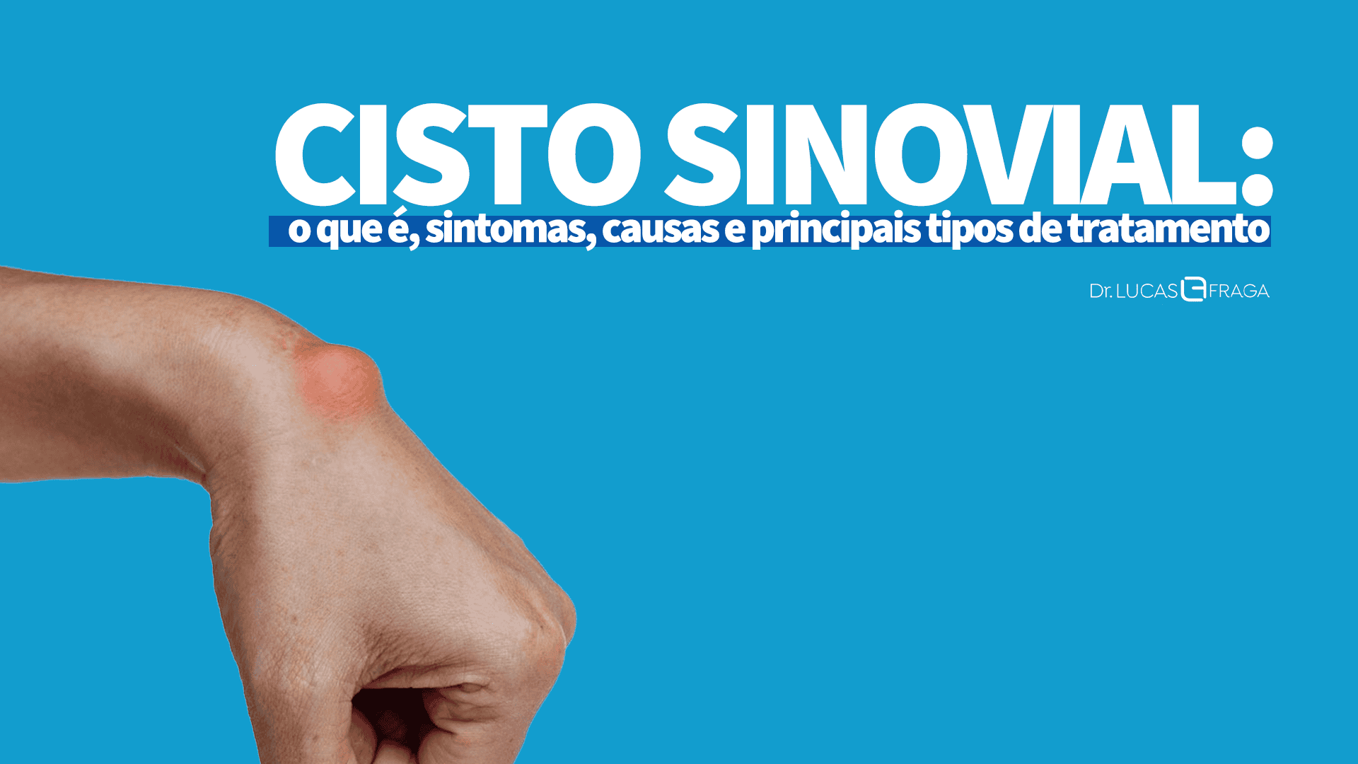 Cisto Sinovial
